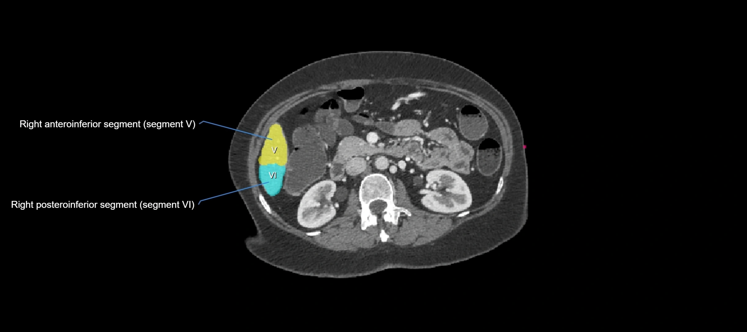 CT liver segments axial cross sectional anatomy labelled image-00016.webp